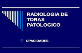 Tórax patológico (opacidades)