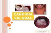 Candidiasis Oral - Patología