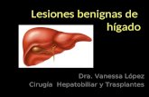 Lesiones benignas de hígado Dra. Vanessa López Cirugía Hepatobiliar y Trasplantes.