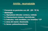 Artritis reumatoide Frecuente en pacientes con AR (29 - 75 %) Frecuente en pacientes con AR (29 - 75 %) Histología: Histología: 1. Hiperplasia folicular: