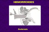 Esclerosis HEMORROIDES. Ligaduras Técnica de Barron.