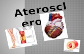 Aterosclerosis es la acumulación de depósitos adiposos llamados placa en el interior de las paredes de las arterias. La aterosclerosis es la causa principal.