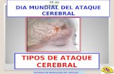 DIA MUNDIAL DEL ATAQUE CEREBRAL SOCIEDAD DE NEUROLOGIA DEL URUGUAY TIPOS DE ATAQUE CEREBRAL 29 de octubre.