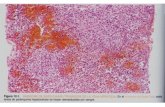 anatomía patologica - Hígado, páncreas y vías biliares