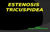 Estenosis tricuspidea