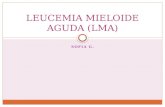 Leucemia mieloide aguda (lma)