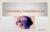 Proceso de Atencion de Enfermeria a Ptes Con Tumores Cerebra Les