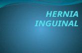 Actualización de Hernia Inguinal