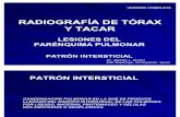 RADIOGRAFÍA DE TÓRAX Y TACAR. PATRÓN INTERSTICIAL. COMPLETO