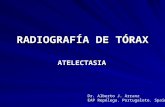 RADIOGRAFÍA DE TÓRAX. ATELECTASIA