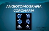 Angiotomografia Coronaria