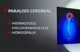 Paralisis cerebral 2013