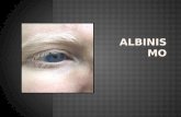 Albinismo y algunos Mitos