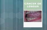 Cancer de lengua