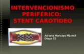 Intervencionismo Periferico Stent Carotideo