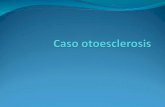 Caso otoesclerosis