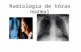 Radiolog­A De T³Rax Normal