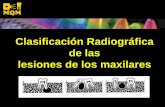 CLASIFICACION RADIOGRAFICA DE LESIONES DE LOS MAXILARES