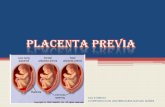 Placenta previa, vasa previa