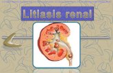 Litiasis renal patología quirúrgica