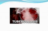 TBC - Tuberculosis general