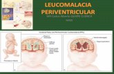 Leucomalacia periventricular