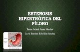 Estenosis hipertrófica-del-píloro