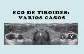 Casos prácticos en Pat Tiroidea: Utilidad de la ECO