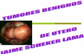 4 tumores benigno de utero 20 nov 2013 (1)
