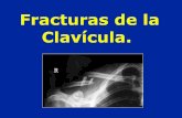 02 Clavicula Fractura Lux Ac Cl