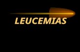 Leucemia 090502225312-phpapp02