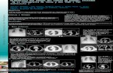 Presentación 164: Diagnóstico por Imagen del cáncer de pulmón: utilidad de la radiografía de tórax y del TCMC ( TAC multicorte )