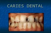 Caries dental consultorio odontologico
