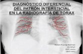Diagnóstico diferencial patron intersticial2003
