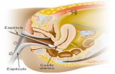 Proceso cancer cervix y utero2 (2)
