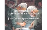 Intervenciones quirúrgicas en acalasia