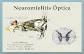 NMO (neuromielitis óptica)