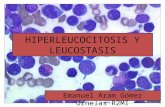 Hiperleucocitosis y Leucostasis