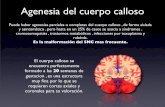 Agenesia Del Cuerpo Calloso