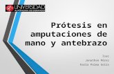 Prótesis en Amputaciones de Mano y Antebrazo