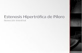 Estenosis Hipertrófica de Píloro y Resección Intestinal