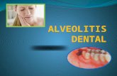 Alveolitis Dental Exposicion