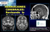 HERNIACIONES CEREBRALES: Revisando lo fundamental A. Gallardo Juan, M.J. Guillém Llácer, A. Glez-Cruz Soler, I. Elía Martínez, V. Martínez Sanjuán, J.