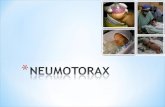 * El neumot³rax es una acumulaci³n de aire extrapulmonar dentro del t³rax. * 1-2% de todos los RN presenta neumot³rax asintomticos, normalmente unilaterales