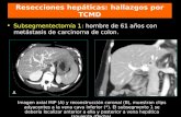 Subsegmentectomía 1: hombre de 61 años con metástasis de carcinoma de colon. Resecciones hepáticas: hallazgos por TCMD Imagen axial MIP (A) y reconstrucción.