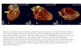 Figura 1: anatomía de las arterias coronarias en un cardio-TC con sincronismo cardiaco: (a) Imagen anterior oblicua del corazón en volume rendering (VR)