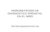 HIDRONEFROSIS DE DIAGNÓSTICO PRENATAL EN EL NIÑO .