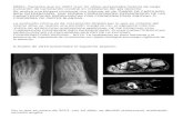 MMRL: Paciente que en 2007 (con 41 años) presentaba historia de larga evolución de tumoración condral en metatarso del pie derecho. Se realiza una biopsia.