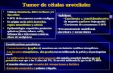 Tumor de células uroteliales Clínica: hematuria, dolor en flanco y/o tipo cólico 5-10% de los tumores renales malignos Se origina en la pelvis (urotelio),