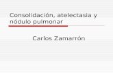 Consolidación, atelectasia y nódulo pulmonar Carlos Zamarrón.